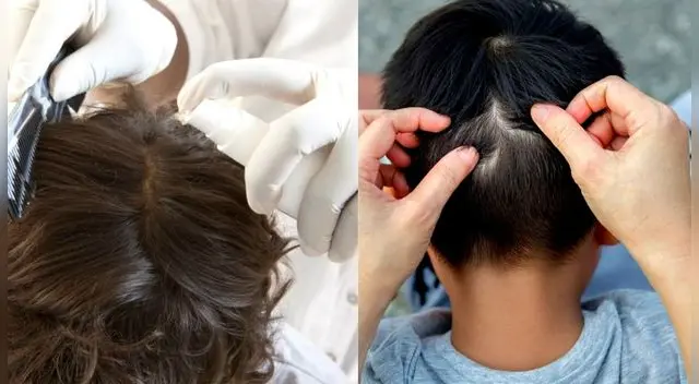 Los liendres generan picazón en el pelo. Los liendres generan picazón en el pelo.