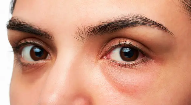 Cómo quitar los ojos hinchados por llorar