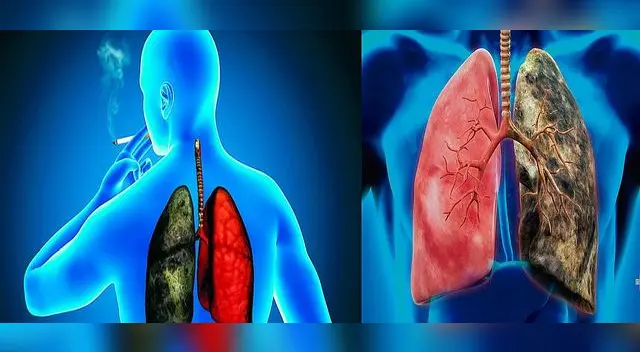 El cáncer de pulmón es uno de los más letales.