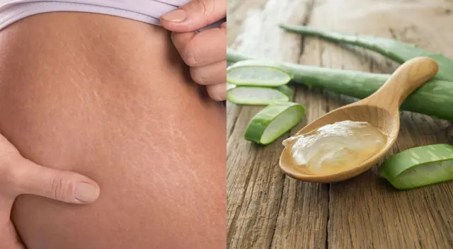 El aloe vera favorece la cicatrización.