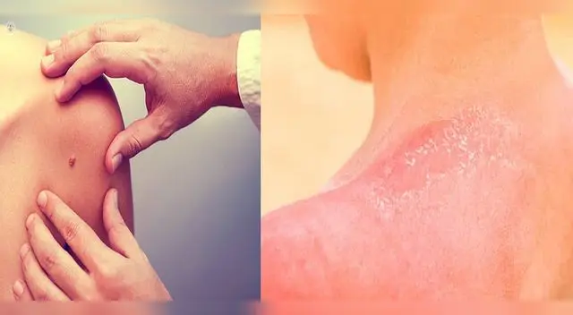 Cuidado con el cáncer de piel. Evita exponerte al sol sin bloqueador y revisa tus lunares.