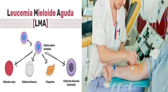 Tenga cuidado con la leucemia mieloide aguda.