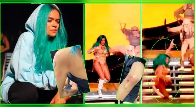 Karol G comparte con sus seguidores los golpes que tiene en su cuerpo tras accidente en su concierto.