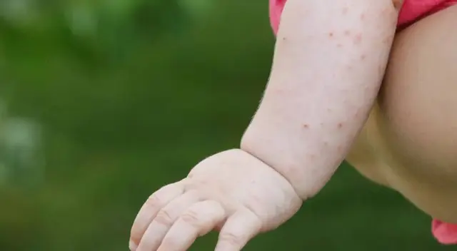 ¿Qué es el Prurigo infantil?