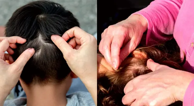 Los piojos cuando no se tratan resulta un problema para tu entorno. Los piojos cuando no se tratan resulta un problema para tu entorno.