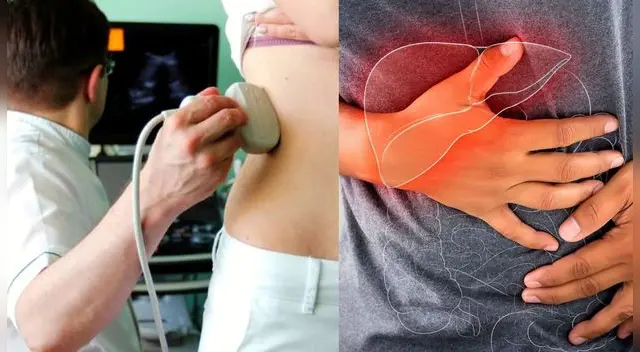 Normalmente los síntomas aparecen en las etapas avanzadas del cáncer de hígao.