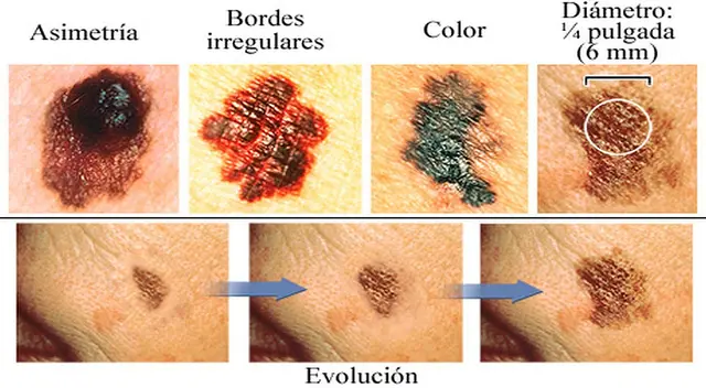 El cáncer de piel se puede tratar si lo detectas a tiempo. Ten en cuentas las señales. El cáncer de piel se puede tratar si lo detectas a tiempo. Ten en cuentas las señales.