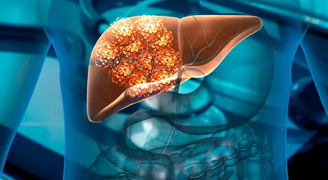 El cáncer de hígado se presenta en personas de 50 años a más.