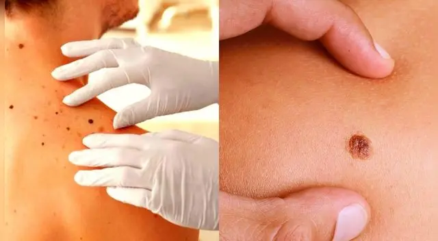 Sospecha de los lunares que tienen un crecimiento excesivo. Sospecha de los lunares que tienen un crecimiento excesivo.