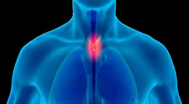 Síntomas del cáncer de esófago en la etapa inicial. Síntomas del cáncer de esófago en la etapa inicial.