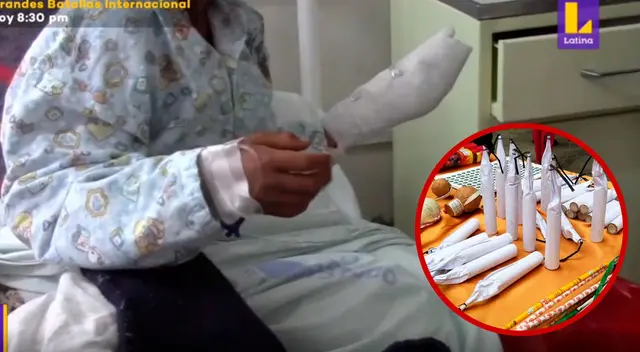 Los médicos no tuvieron otra opción de realizarle una amputación parcial de los dedos, pero afortunadamente el menor se viene recuperando favorablemente. Los médicos no tuvieron otra opción de realizarle una amputación parcial de los dedos, pero afortunadamente el menor se viene recuperando favorablemente.