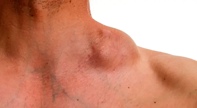 Cómo reconocer los síntomas del cáncer linfático Cómo reconocer los síntomas del cáncer linfático