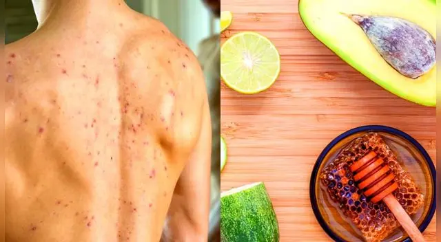 Evitar tener estrés y una mala alimentación porque puede generar acné.