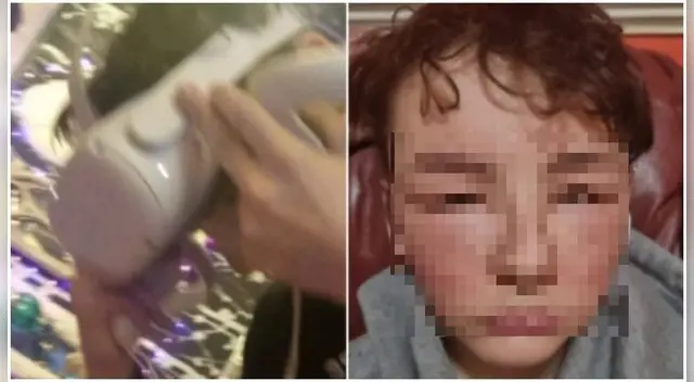 El adolescente ya tenía una pequeña hinchazón, que terminó agravándose mucho a la mañana siguiente.