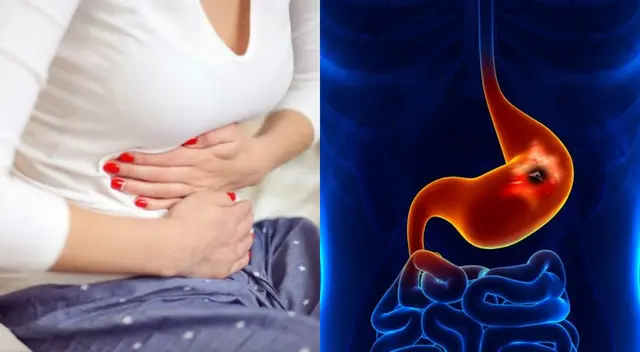 Pueden aparecer por bacterias o por el uso continuo de medicamentos antiiflamatorios.