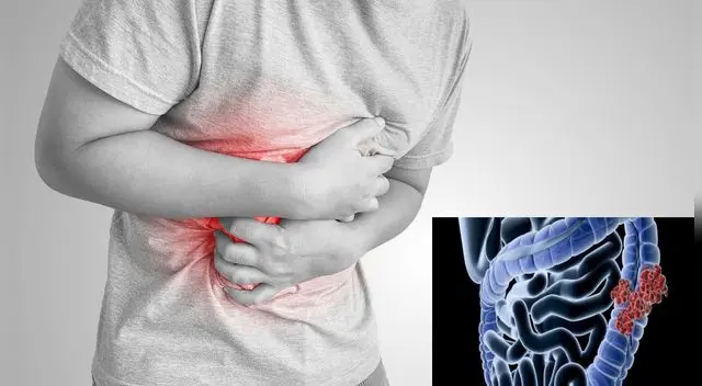 Atento al cáncer de colon.