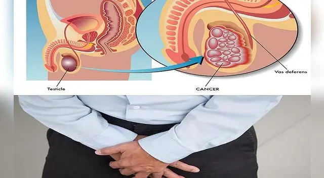 Cuidado con el cáncer de próstata. Siempre hazte chequeos.