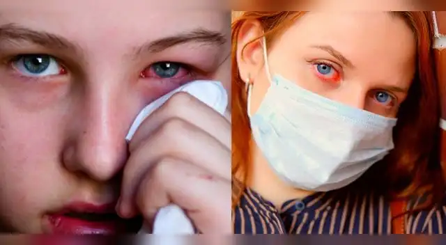 Acudir al oftalmólogo de tener síntomas de una conjuntivitis.