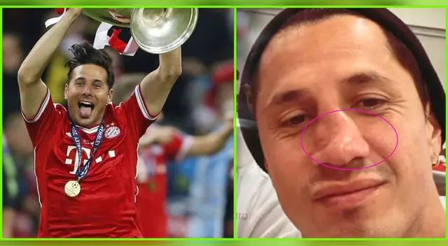 En la celebración de la selección peruana, Gianluca mostró como quedó su nariz: totalmente aplastada.
