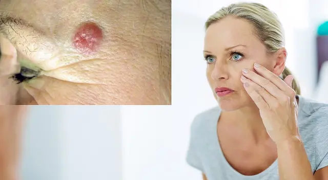 Cáncer de piel, cómo detectarlo.