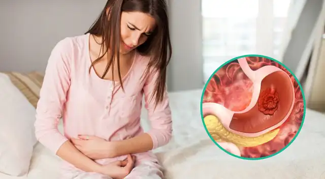 Los síntomas de cáncer de estómago a menudo se confunden con un virus o úlceras estomacales. Los síntomas de cáncer de estómago a menudo se confunden con un virus o úlceras estomacales.