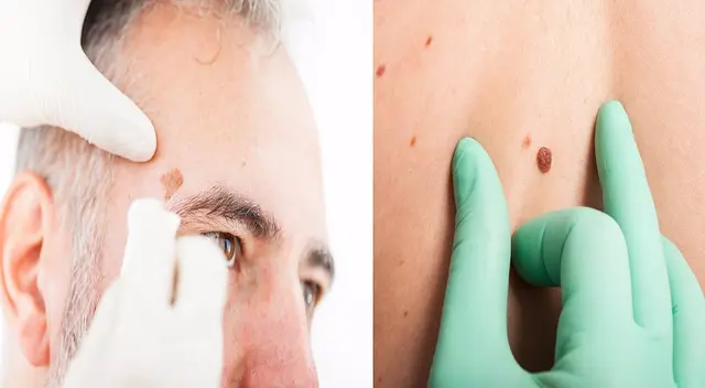 Presta atención a los signos del cáncer de piel. Presta atención a los signos del cáncer de piel.