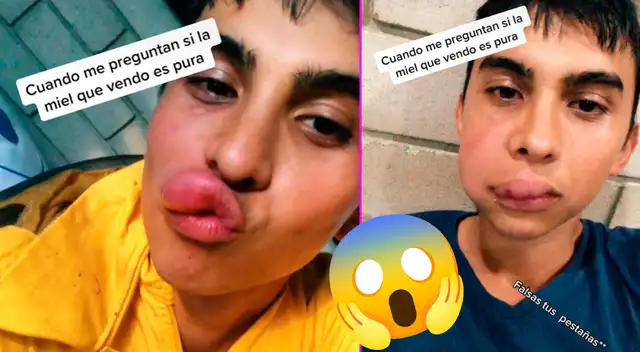 El joven hizo una recopilación de sus picaduras.