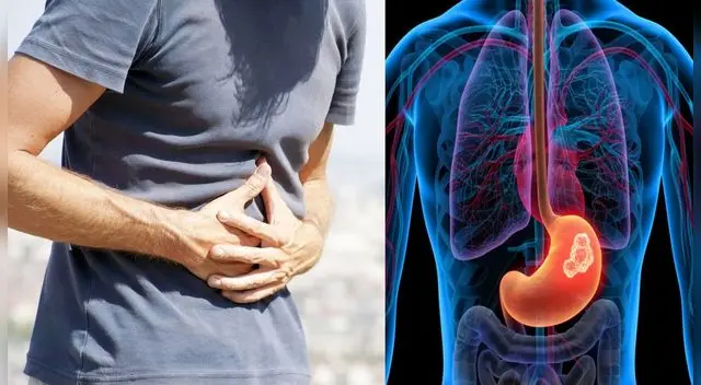 Aprende a reconocer los síntomas del cáncer de estómago.
