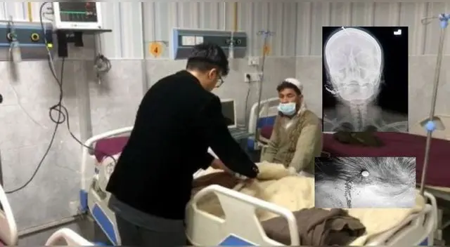 Curandero insertó un clavo en la cabeza de una embarazada para que tenga un hijo varón