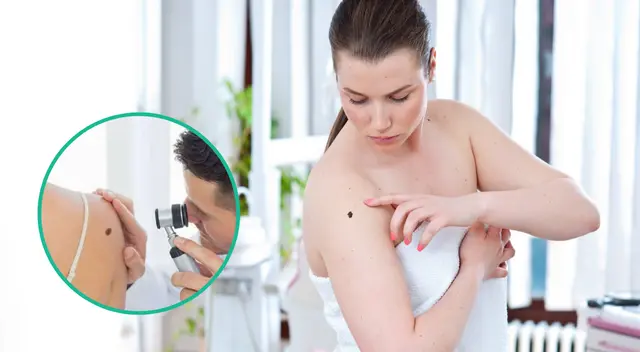 Los lunares oscuros son más propensos a convertirse en cáncer de piel.