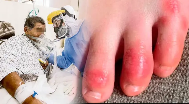 Nuevo síntoma de la variante ómicron de la COVID-19