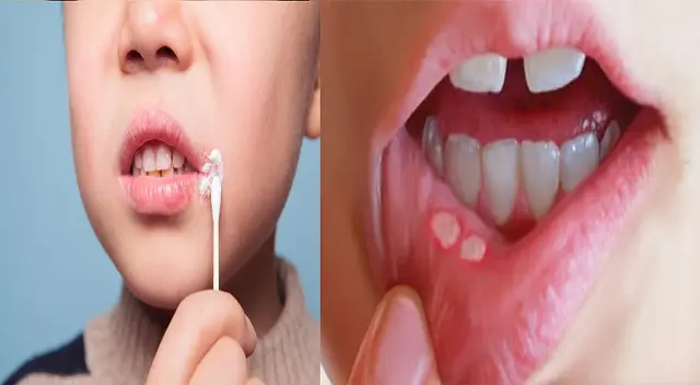 Los "fuegos" en la boca son pequeñas úlceras. Los "fuegos" en la boca son pequeñas úlceras.