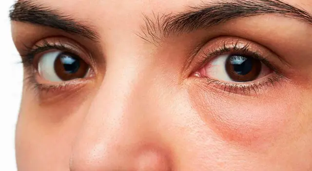 Remedios caseros para las ojeras Remedios caseros para las ojeras