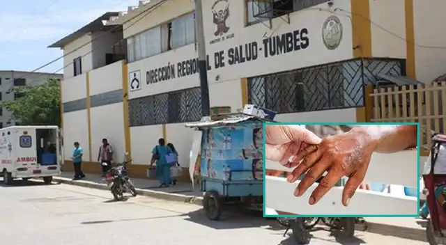La Dirección Regional de Salud afirmó que sería el primer caso de lepra en Tumbes.