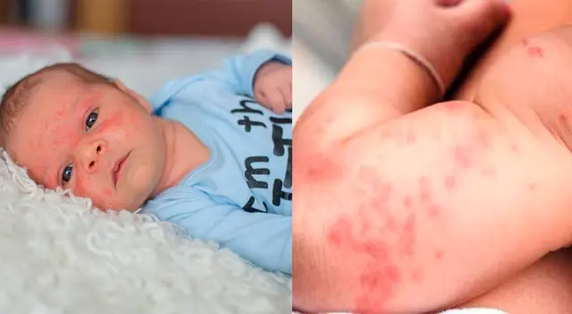 Trucos caseros para eliminar el sarpullido