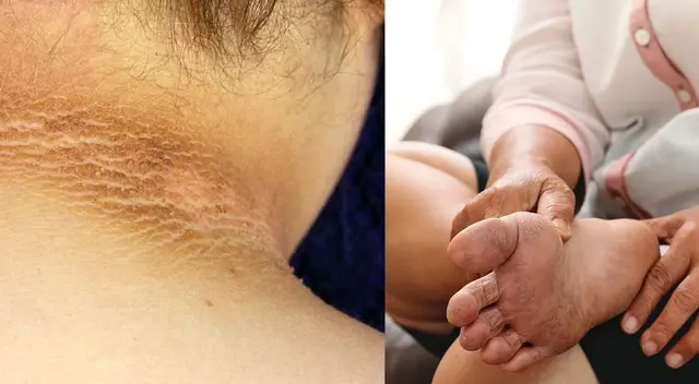 Marcas en la piel que son síntomas de diabetes.