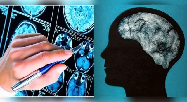 Nuevos estudios revelan daños al cerebro vinculados al COVID-19.