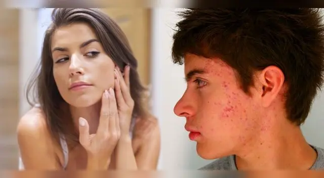 El acné no solo aparece en la adolescencia, también esta presente en los adultos. El acné no solo aparece en la adolescencia, también esta presente en los adultos.