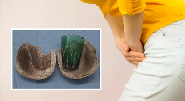 El vaso estaba encerrado por un cálculo de 8 centímetros de ancho.