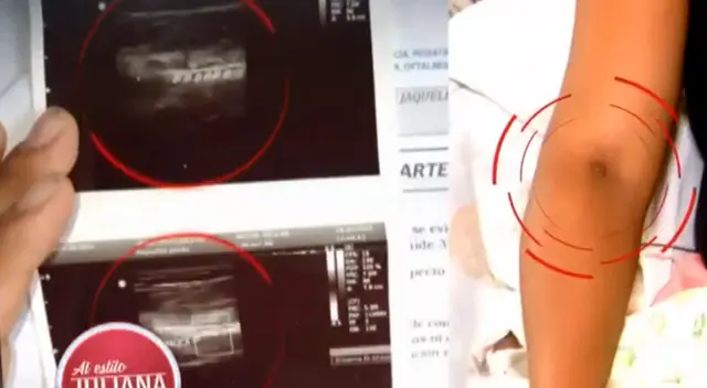 Mujer padece dolores tras tener un catéter dentro de su vena.