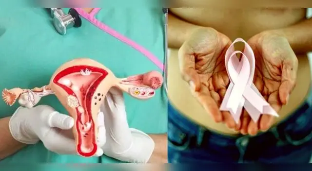 Solo en EE.UU la Sociedad Americana Contra El Cáncer estima que  4,280 mujeres morirán por cáncer de cuello uterino.