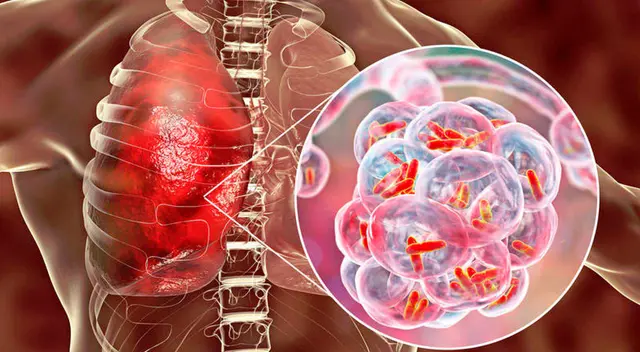 Conoce AQUÍ todos los detalles sobre la tuberculosis pulmonar.