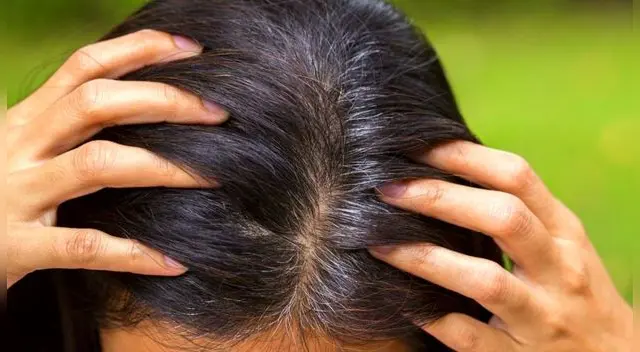 Hsy varios motivos de la aparición de la caspa