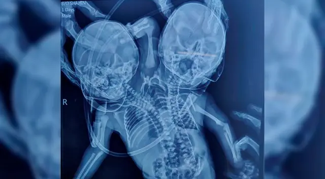 El estado del bebé sigue siendo incierto en los primeros días.