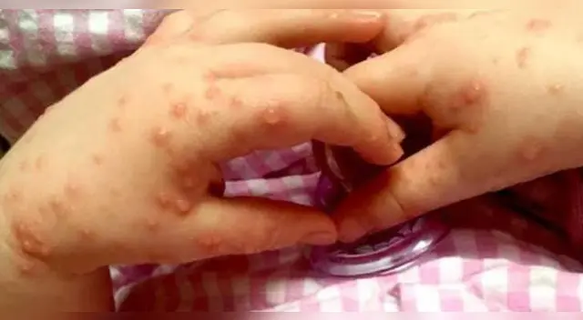 Dirección Regional de Salud, aseguró que coxsackie ataca principalmente a menores de 5 años.