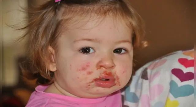 Conoce qué es el Virus Coxsackie