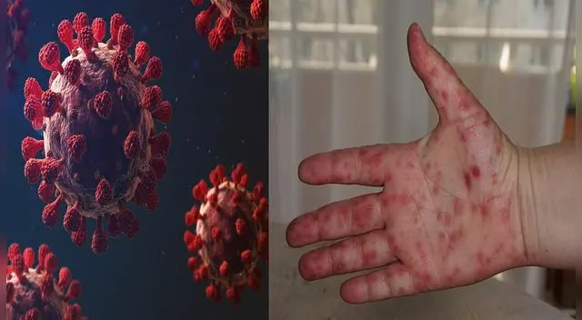 Conoce cuál es la diferente en la sintomatología del COVID-19 y el Virus Coxsackie.