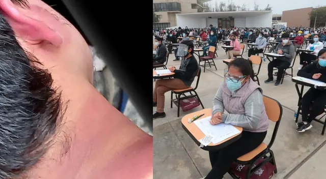 Alumnos terminan con quemaduras en la piel