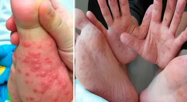 Reportan más brotes del virus coxsackie a nivel nacional. Reportan más brotes del virus coxsackie a nivel nacional.