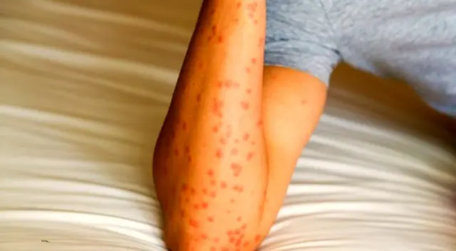 Se alimentan de la sangre de los mamíferos como lo hace la garrrapata.